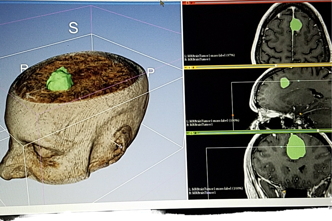 Brain Cancer MRI Scan (Sample)