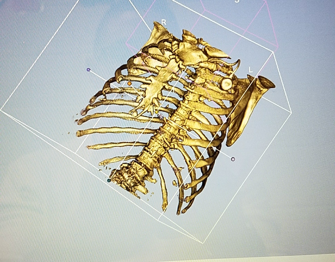 Human Torso Skeleton CT Scan (Sample)