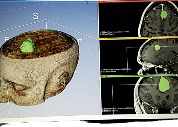 Brain Cancer MRI Scan (Sample)